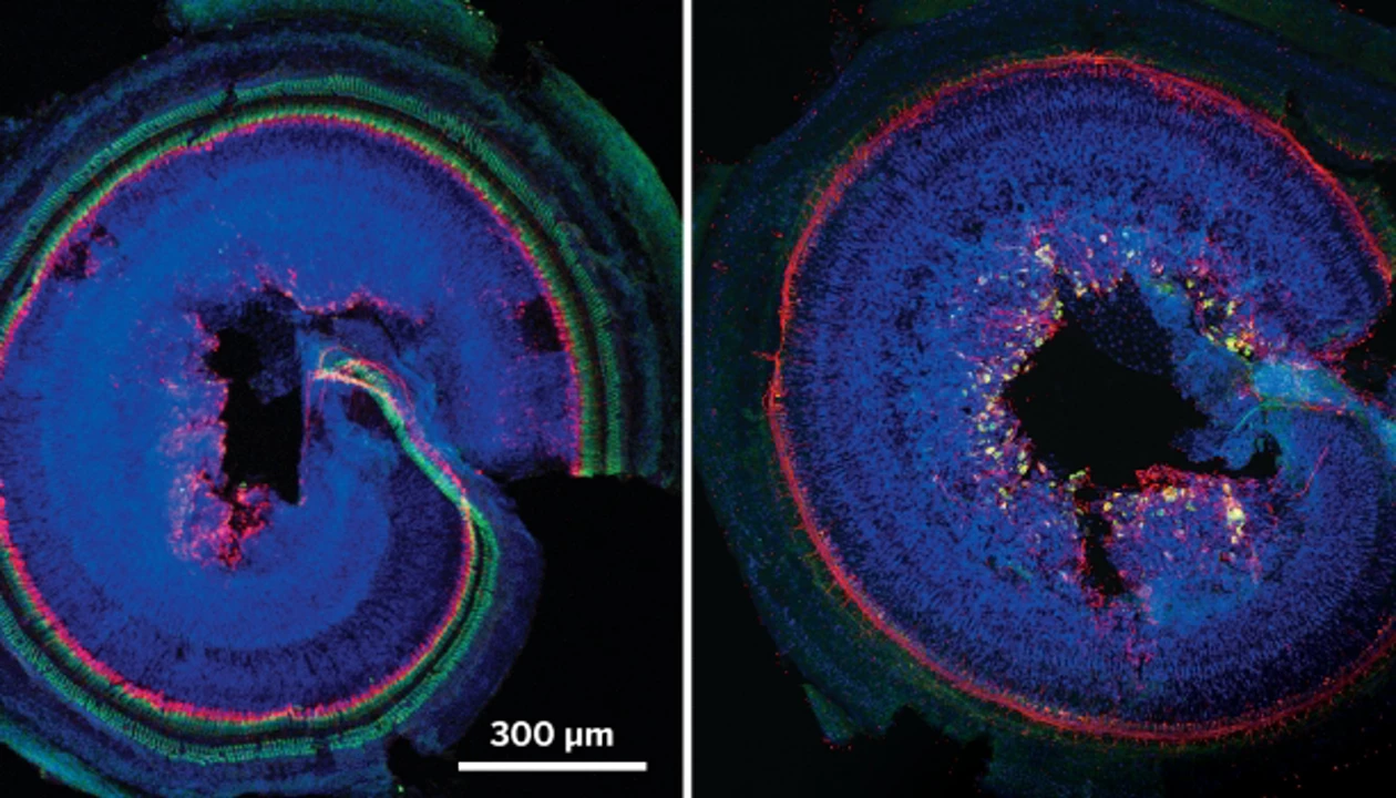 glutathione ear ringing What's the buzz? The neuroscience and the treatment of tinnitus | Physiological Reviews Lipo-Flavonoid Plus Inner Ear Health