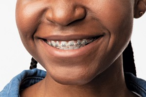 A close-up of orthodontic braces.