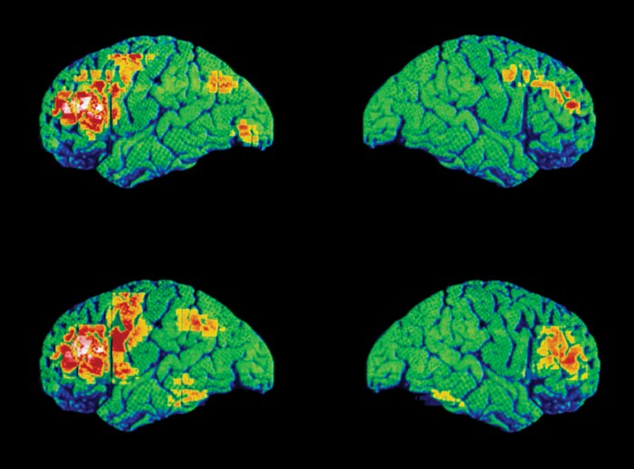 A colored positron-emission tomography scan of the brain of a person with schizophrenia.