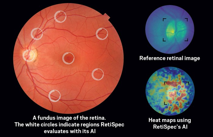 A heat map illustration shows where biomarkers of Alzheimer's disease light up on a retinal-scan image.