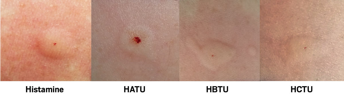 ipamorelin allergic reaction Peptide coupling agents can cause severe reactions Plastic Surgery Case Study Size:60ml accessories