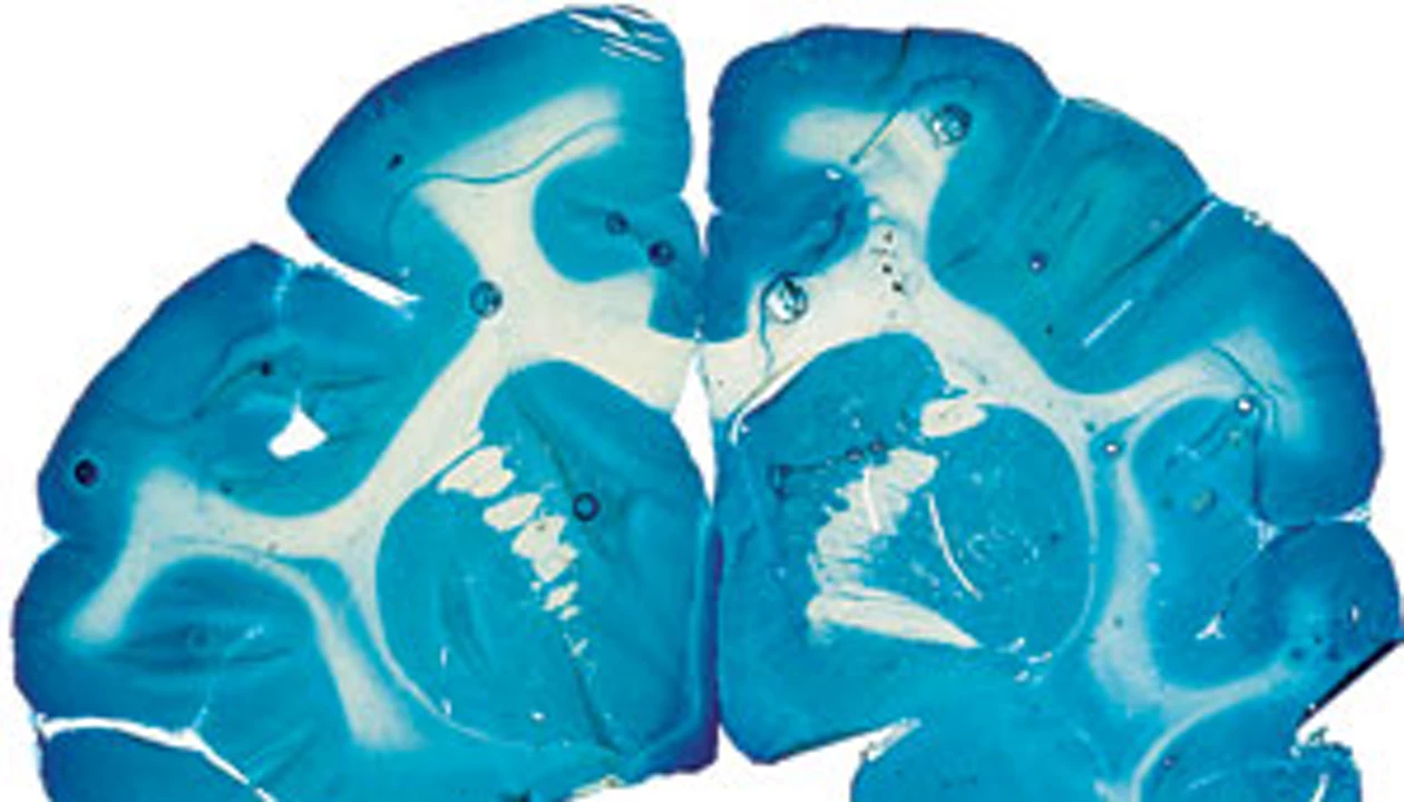 Brain Barricade