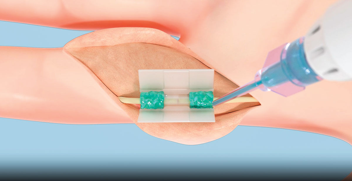 A ilustração mostra o reparo de um nervo seccionado em um dedo. O nervo é mantido em um canal transparente apoiado em um molde de silicone. Uma seringa aplica uma substância gelatinosa azul-esverdeada nas junções entre o nervo e o canal.