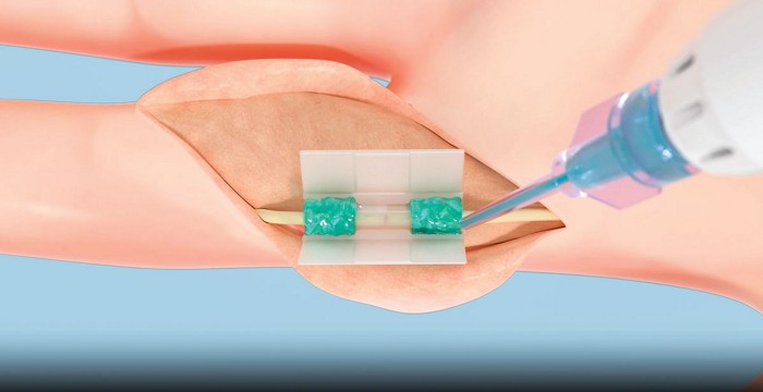 FDA approves light-activated polymer for nerve repair without stitches