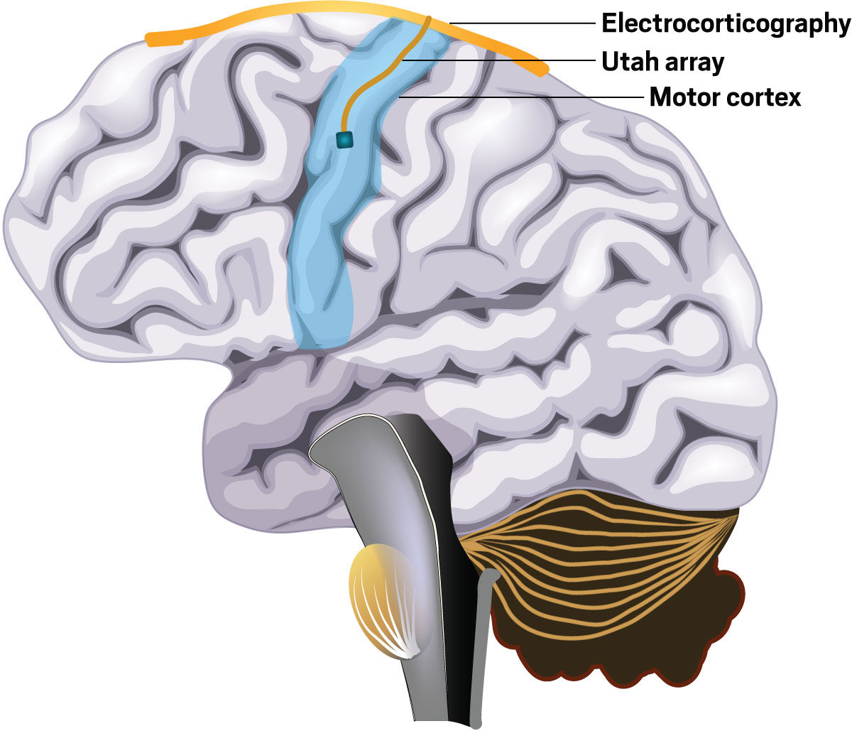 A graphic of a brain, with the motor cortex highlighted in blue. On top of the brain, there is a thick, orange line depicting a surface electrode stuck along the surface, labeled electrocorticography. On the side of the brain, on the blue area, there is a square with a gold wire, labeled as a Utah array.