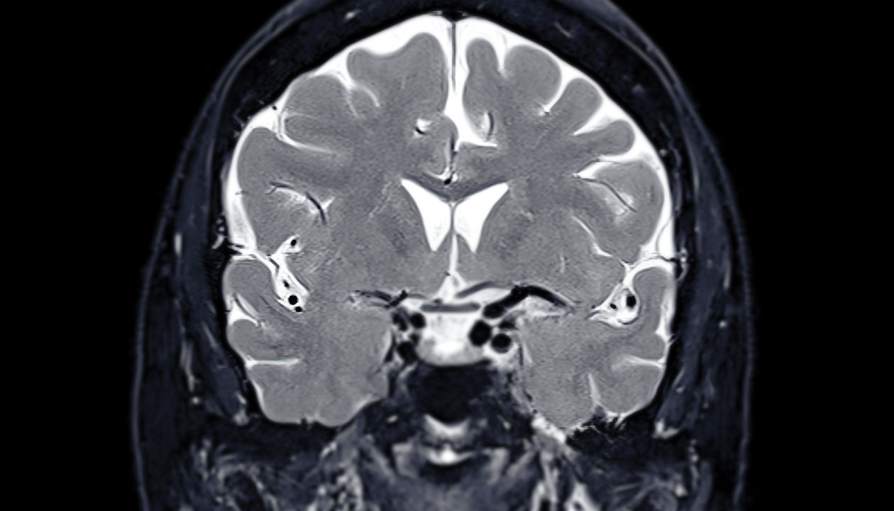 Kasvu Therapeutics goes after a different neuroplasticity target to treat depression