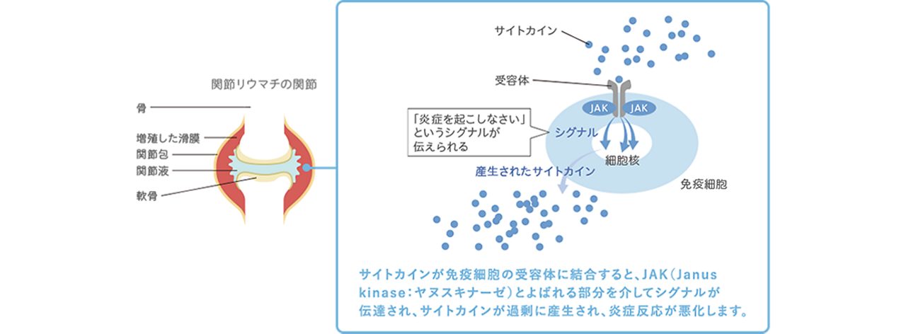 関節リウマチの状態とシグナル伝達