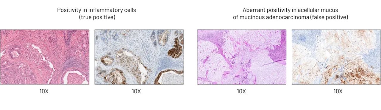 Negative staining in inflammatory cells (true negative) and aberrant positivity in acellular mucus of mucinous adenocarcinoma (false positive)