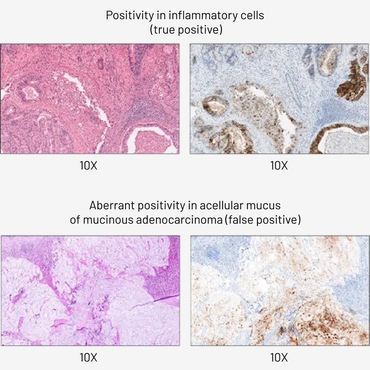 Negative staining in inflammatory cells (true negative) and aberrant positivity in acellular mucus of mucinous adenocarcinoma (false positive)