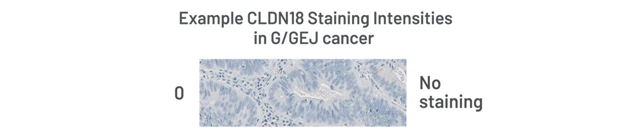 Example CLDN18 Staining Intensities in G/GEJ cancer 