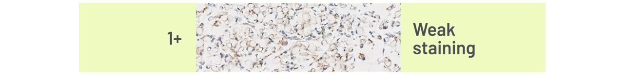 Example CLDN18 Staining Intensities in G/GEJ cancer 
