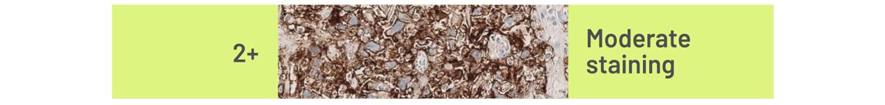 Example CLDN18 Staining Intensities in G/GEJ cancer 