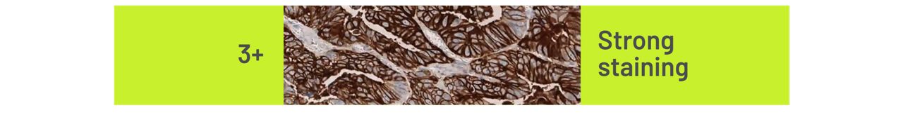 Example CLDN18 Staining Intensities in G/GEJ cancer 