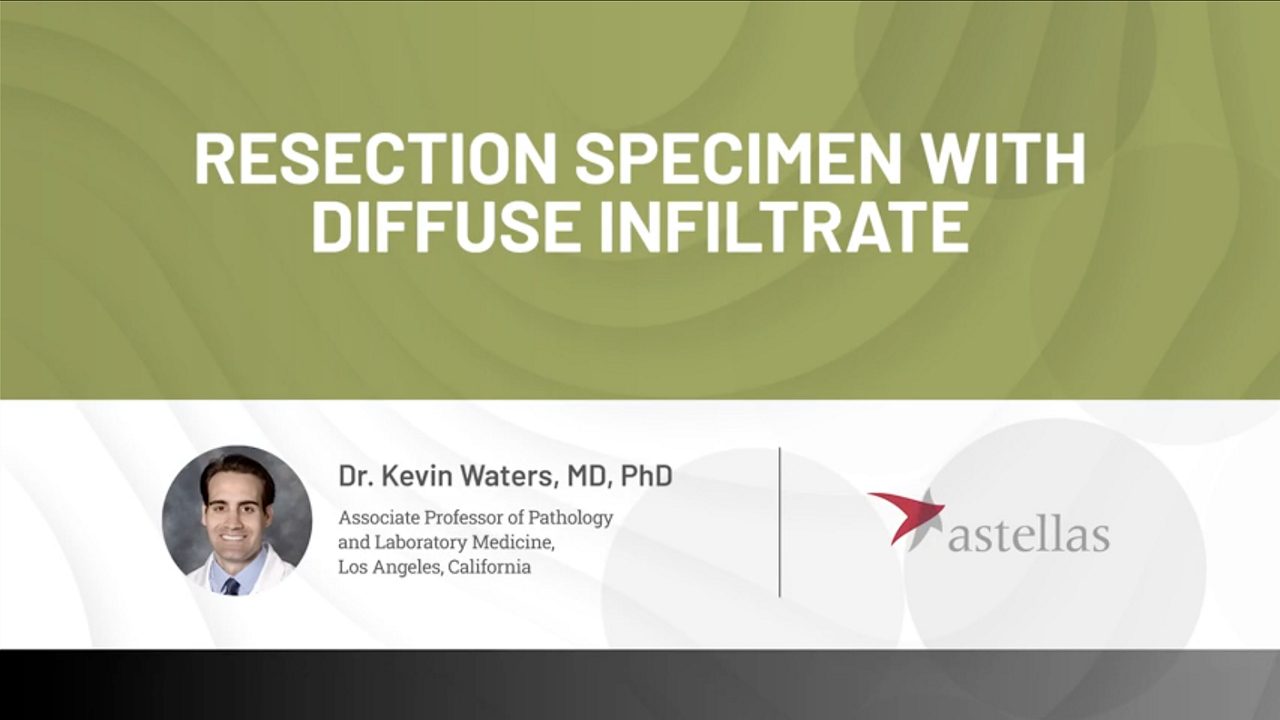    Resection specimen with diffuse infiltrate expert case review