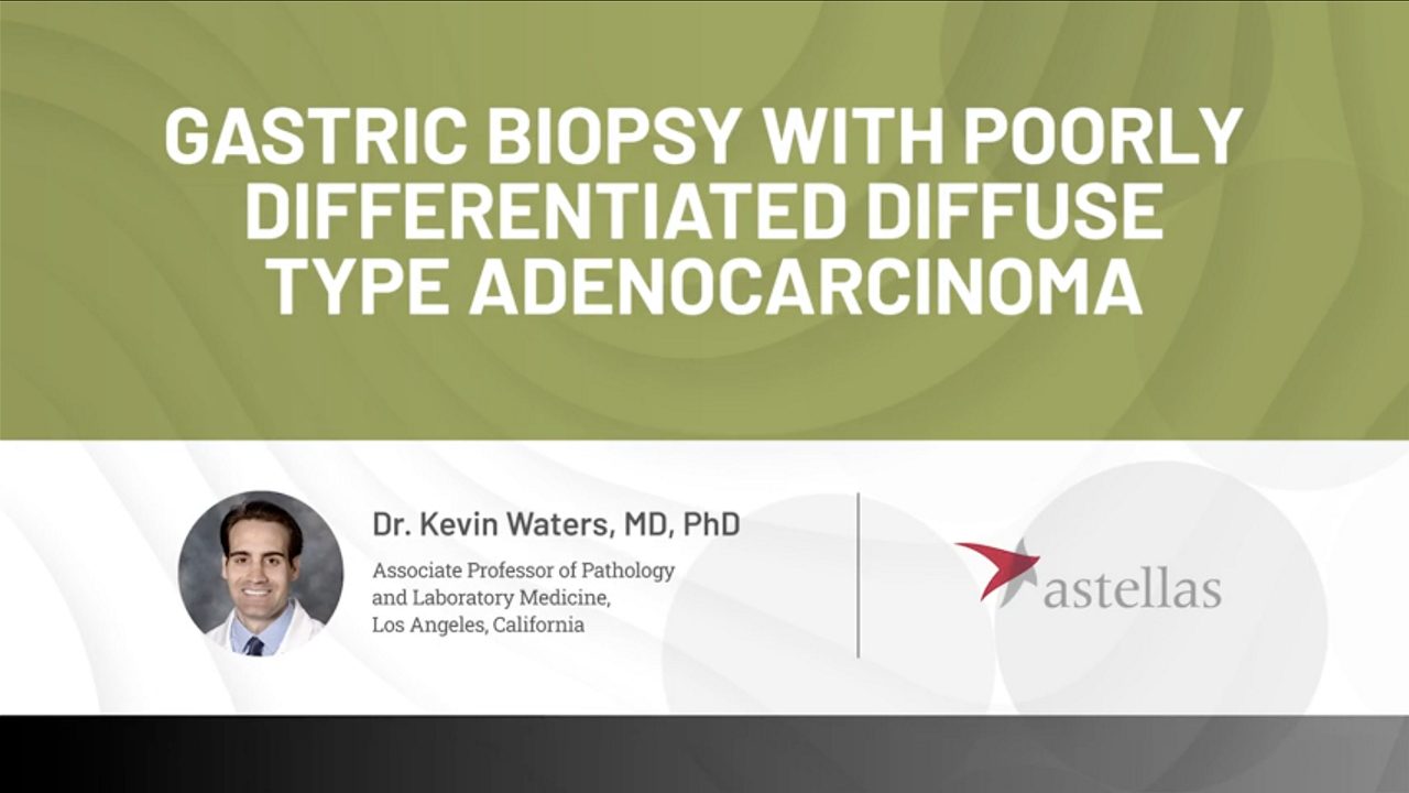      Gastric biopsy with poorly differentiated diffuse type adenocarcinoma expert case review