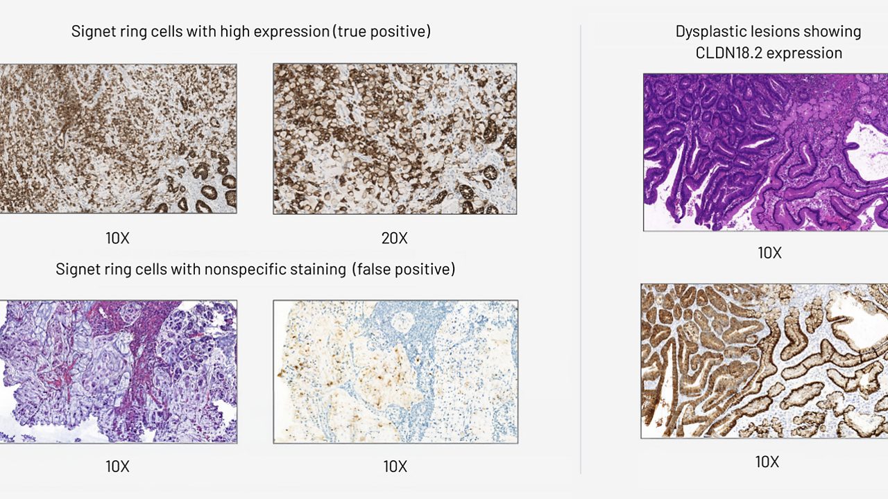 Signet ring cells with high expression, signet ring cells with nonspecific staining and dysplastic lesions showing CLDN18.2 expression 