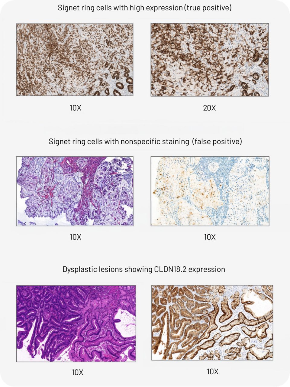 Signet ring cells with high expression, signet ring cells with nonspecific staining and dysplastic lesions showing CLDN18.2 expression 