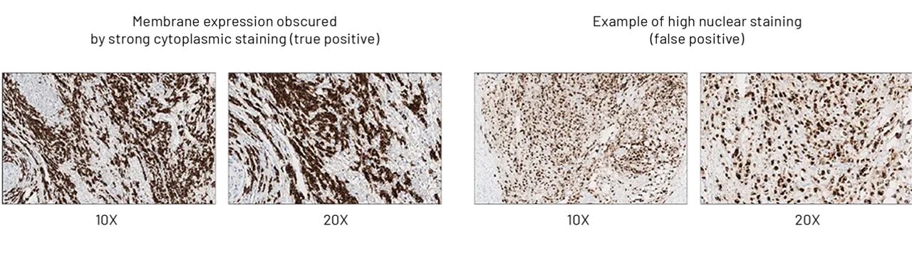 Membrane expression obscured by strong cytoplasmic staining and example of higher nuclear staining
