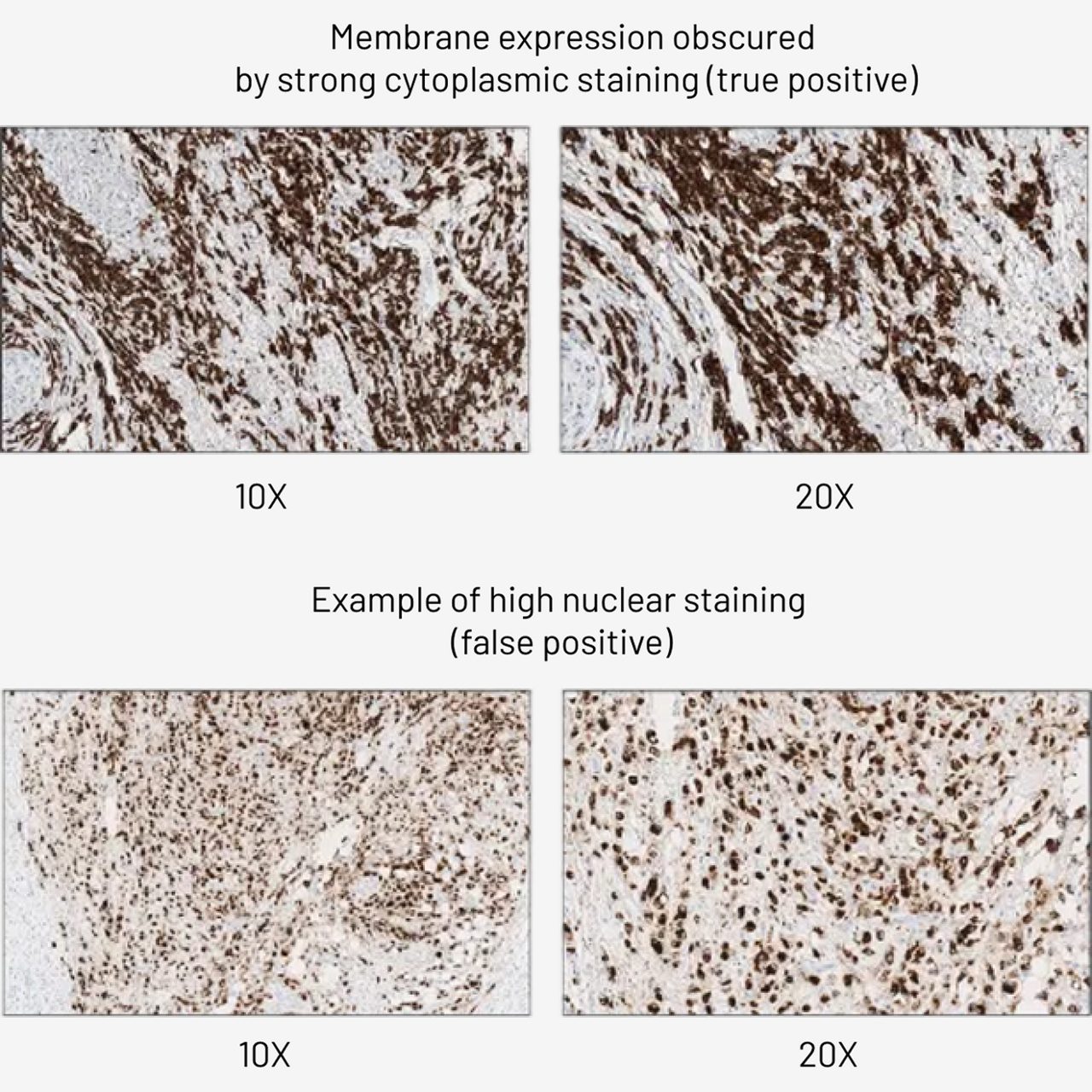 Membrane expression obscured by strong cytoplasmic staining and example of higher nuclear staining