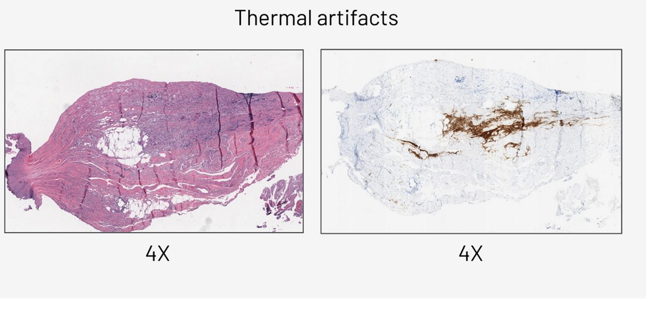 Thermal artifacts 