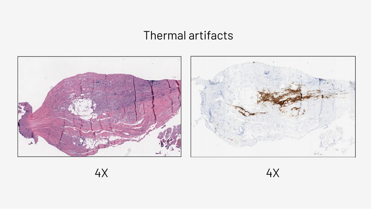 Thermal artifacts 