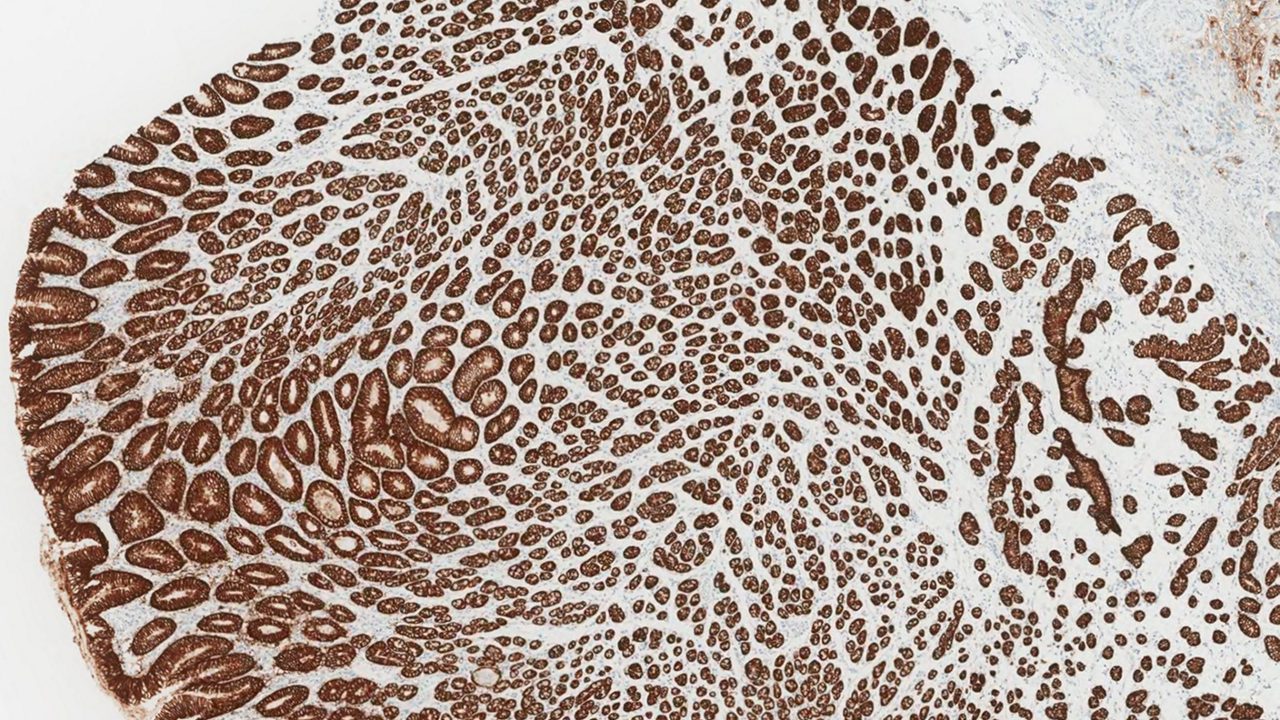 5x magnification of CLDN18-stained normal gastric epithelium and tumor cells 