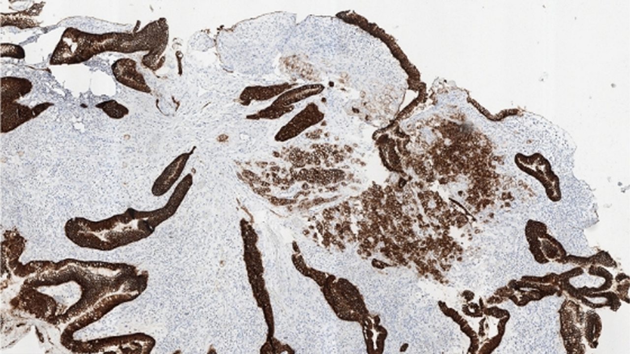 5x magnification of CLDN18-stained tumor sample with surrounding normal gastric glands. 