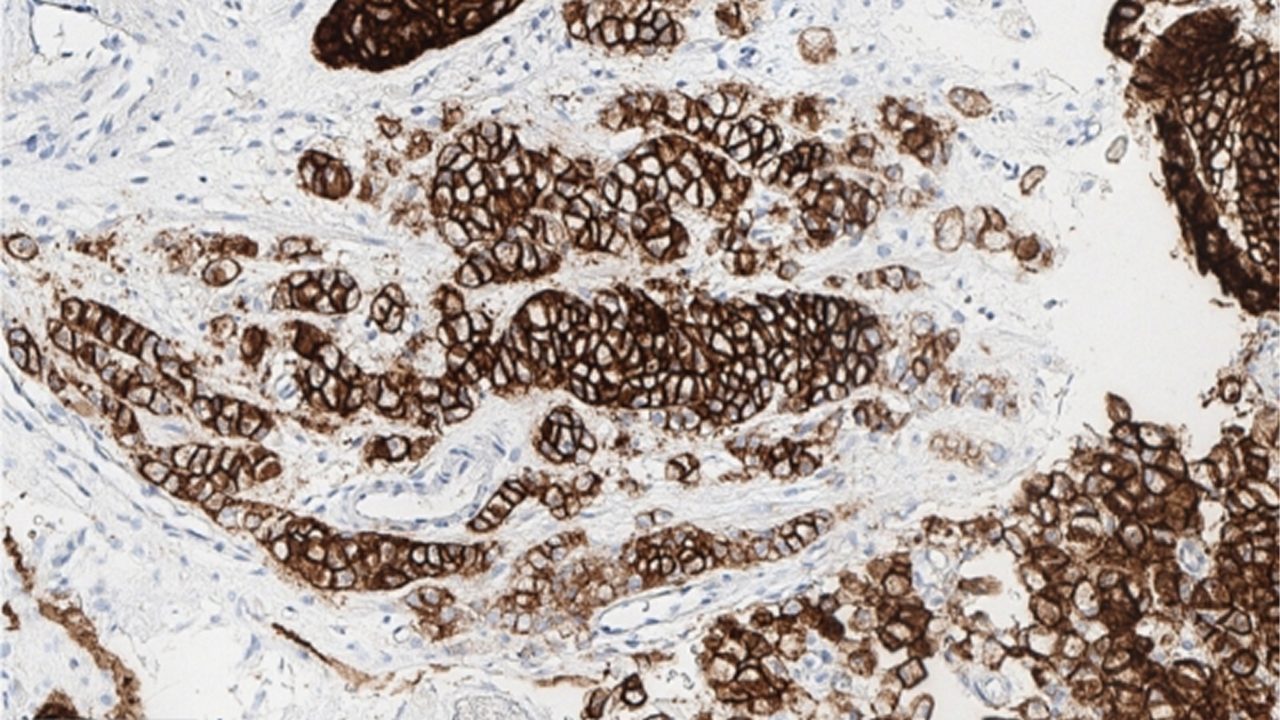 20x magnification demonstrating CLDN18 staining