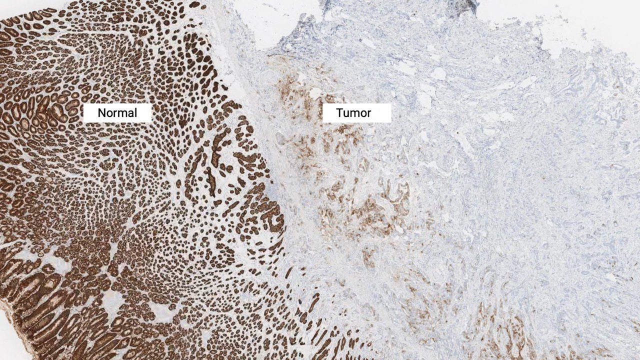 Normal and tumor cell CLDN18.2 staining at 2x magnification