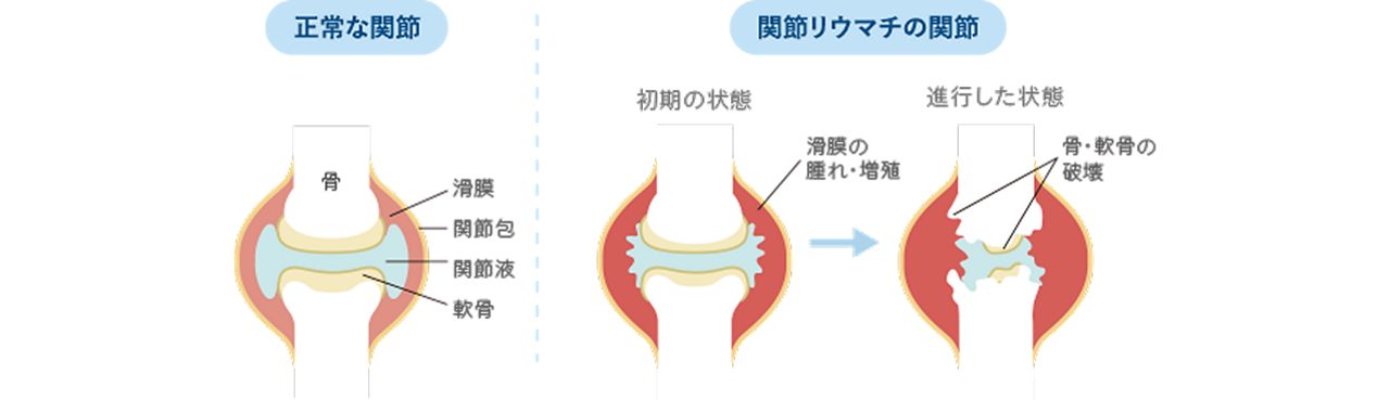 関節の状態