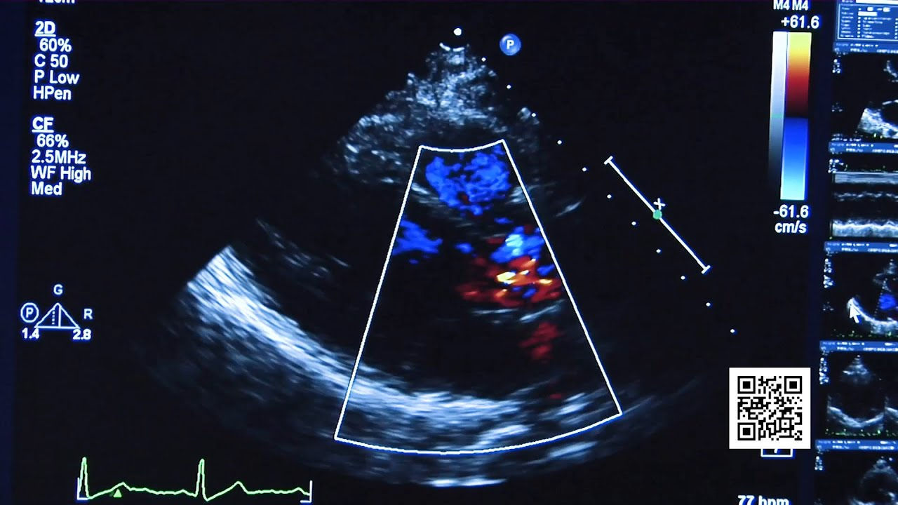 Atrial Fibrillation (Afib) Treatment Options