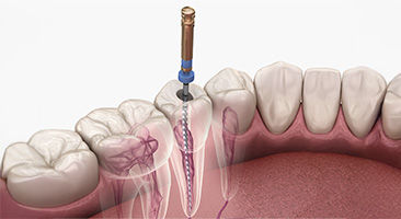 Illustration of a dental file inside a tooth canal, showing endodontic access and anatomy, promoting beginner-level endodontic CE courses.