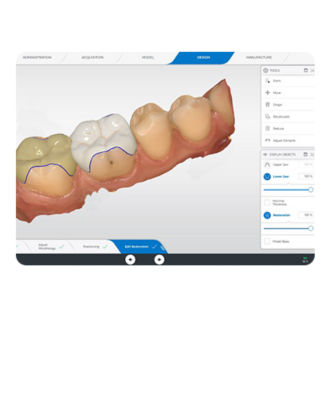 Screenshot of CEREC Software displaying digital tooth restoration design on a monitor.