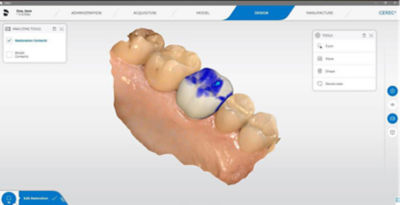 3D dental restoration design displayed in CEREC software interface with crown proposal highlighted.