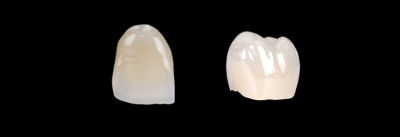 Comparison of CEREC Zirconia meso monochromatic crown and CEREC Cercon 4D multidimensional zirconia crown on TiBase abutments
