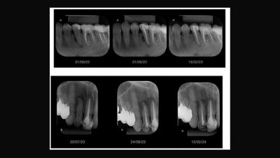 Dental X-ray images showing root canal treatments with high clinical success using ProRoot Bioactive Cement.