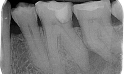Radiograph of the tooth before treatment, showing the complex case with long roots and a calcified system.