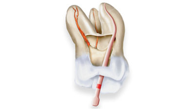 Conform Fit Gutta-Percha points for precise apical fit in root canal treatment.