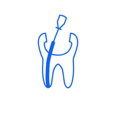 Illustration of a tooth being filled during obturation treatment.