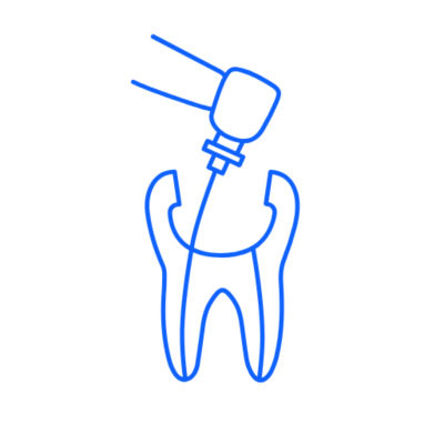 Illustration of a file shaping the root canal inside a tooth.