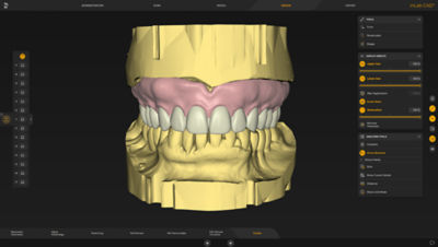 3D dental prosthesis design displayed in inLab CAD software interface with modular design tools.