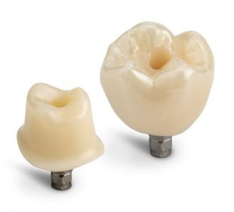 Two CEREC Cercon 4D abutment restorations on TiBase implants designed to mimic natural teeth.