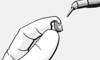 Sandblasting the internal surface of a zirconia crown as pre-treatment before cementation