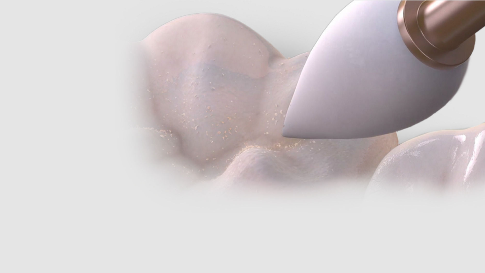 Migliora Le Tazze Di Finitura 30 Tazze Punti Di Finitura Dentale - Foto 14