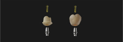 CEREC Cercon 4D zirconia abutment and crown restorations with TiBase connection components