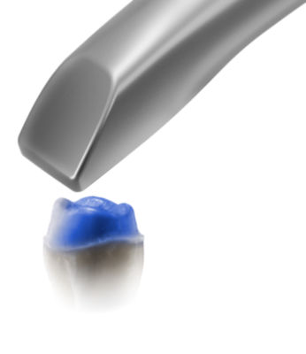 Digital Impression Taking – Scan for In-Office Manufacturing | Dentsply ...