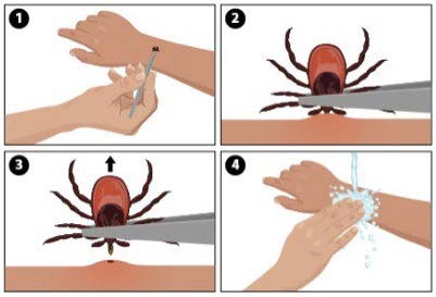 Anaplasmosis Tick Removal