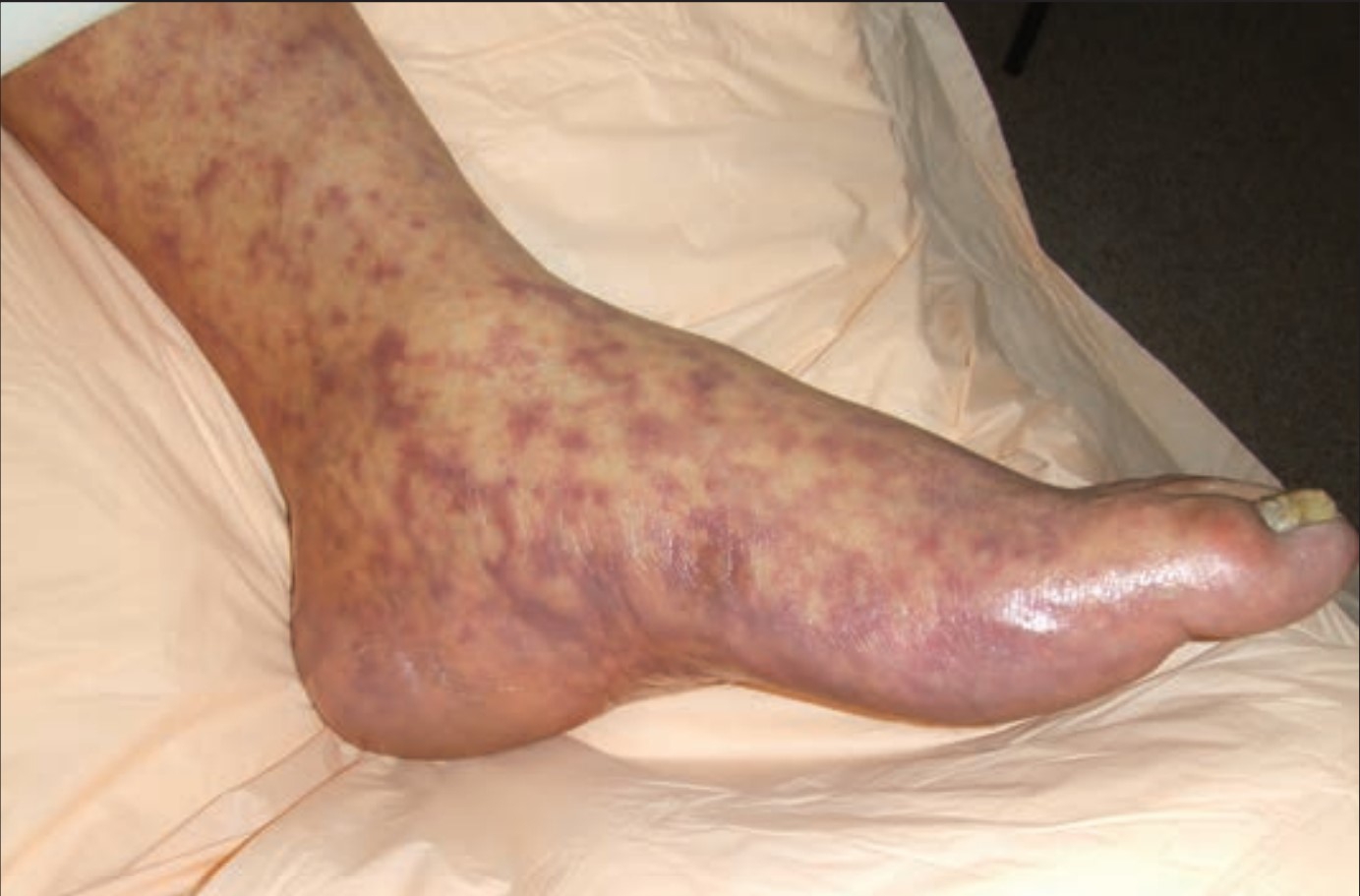 Rocky Mountain Spotted Fever