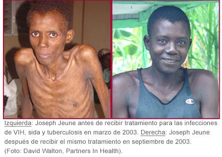Izquierda: Joseph Jeune antes de recibir tratamiento para las infecciones de VIH, sida y tuberculosis en marzo de 2003. Derecha: Joseph Jeune después de recibir el mismo tratamiento en septiembre de 2003. (Foto: David Walton, Partners In Health).
