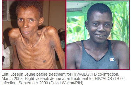 Joseph Jeune before treatment for HIV/AIDS/TB co-infection on the left picture, March 2003 and on the right after treatment September 2003